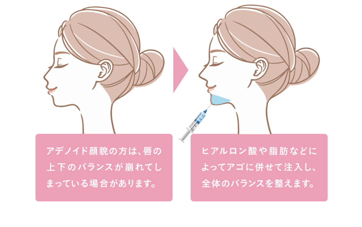 ヒアルロン酸の効果（改善できる症状）