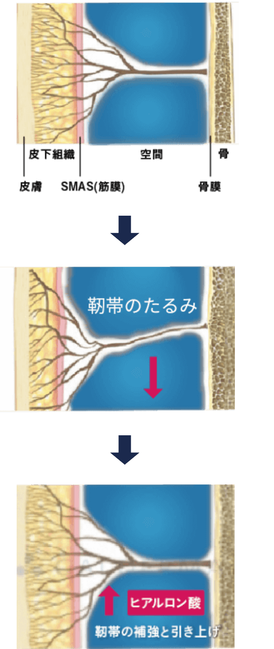 老化による靱帯の変化（イメージ図）