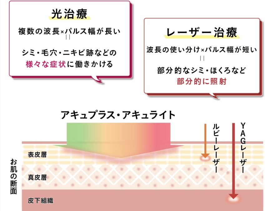 光治療とレーザー治療　違いのイメージ