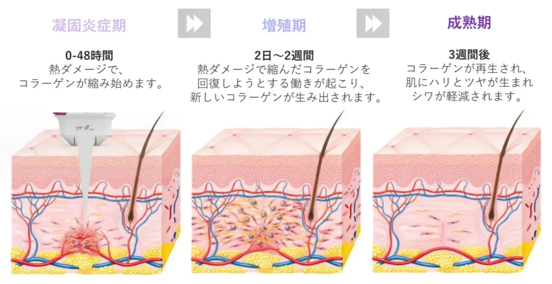 コラーゲンハイフの適応になる方