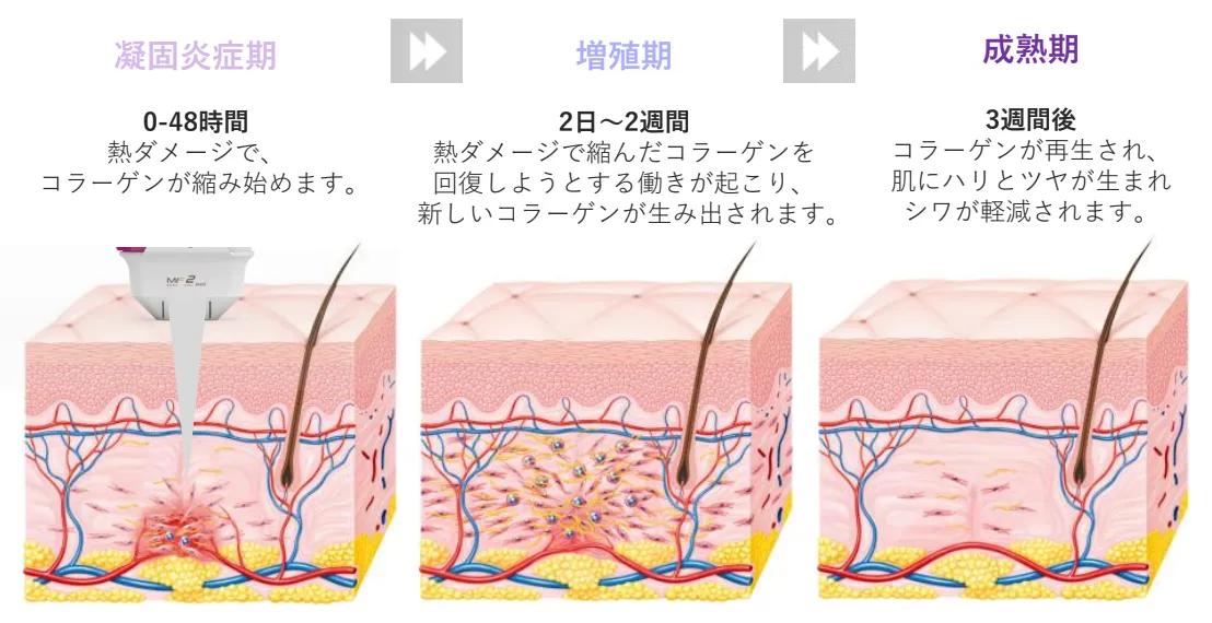 ハイフの効果