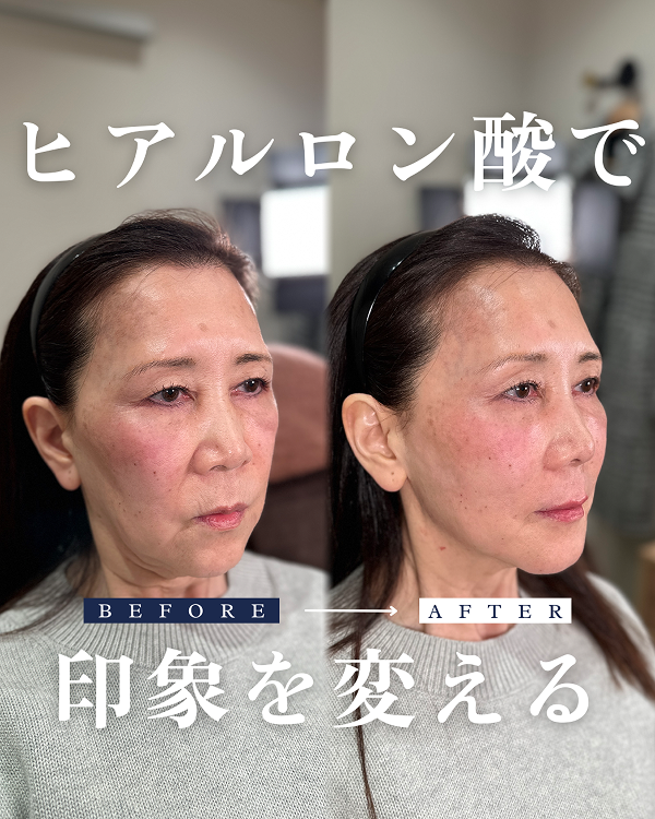 ヒアルロン酸注入によるリフトアップの症例