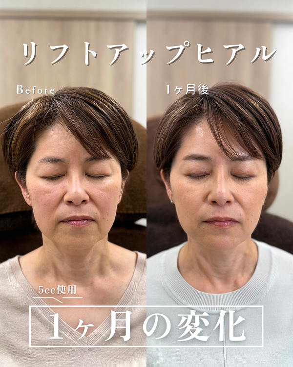 ヒアルロン酸注入によるリフトアップの症例