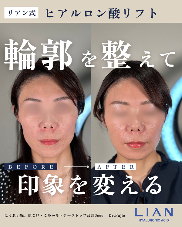 ヒアルロン酸注入によるこめかみ・頬こけの症例