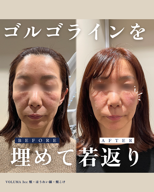 ヒアルロン酸注入による鼻の症例