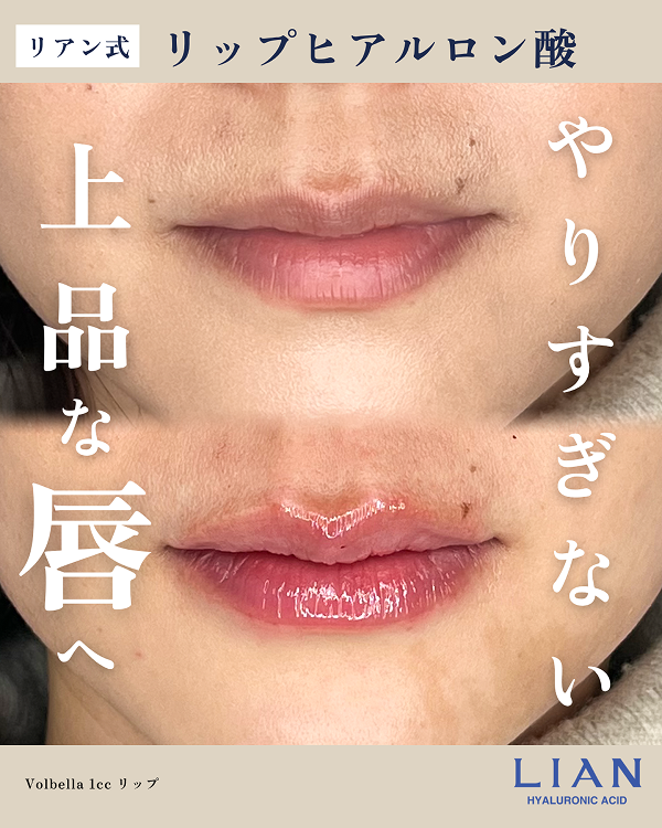 ヒアルロン酸注入によるリップの症例