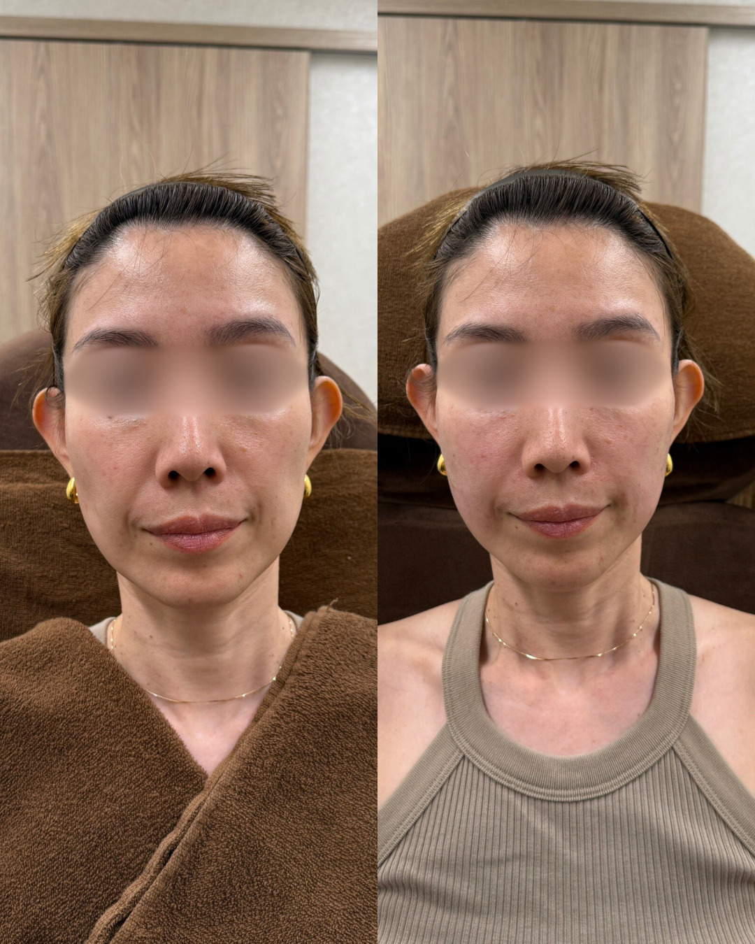 ヒアルロン酸3cc