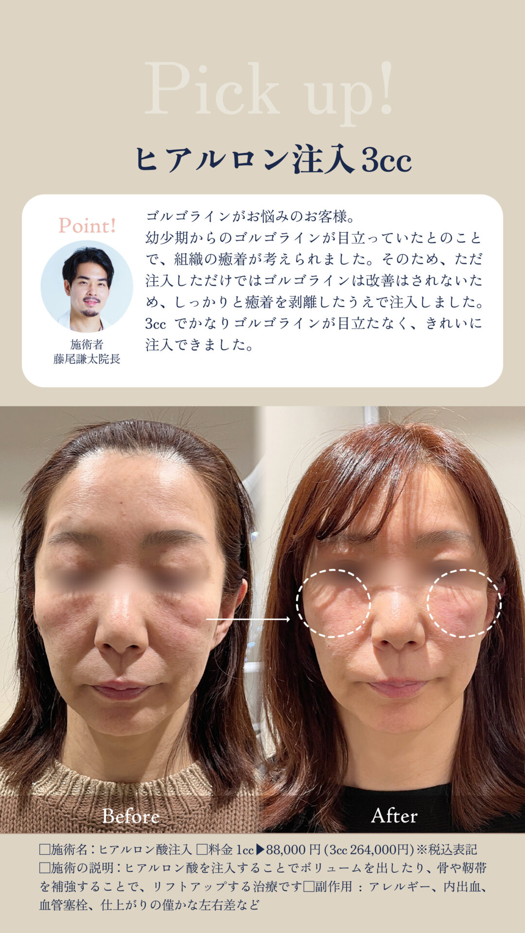 ヒアルロン酸(ゴルゴライン)