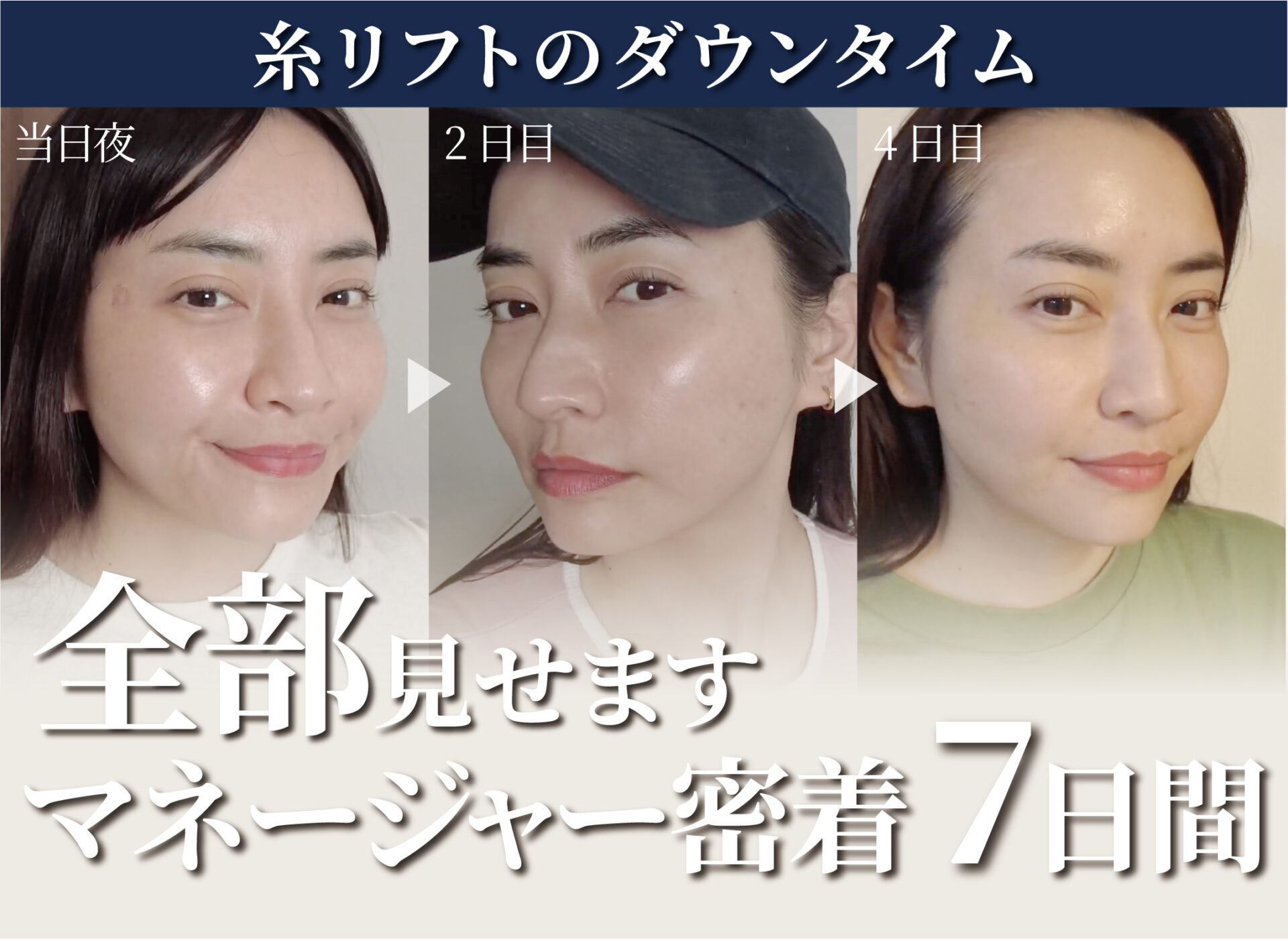 【Youtube】マネージャー密着7日間 ‼︎  院長がマネージャーに糸リフトを入れる動画をUPしました！
