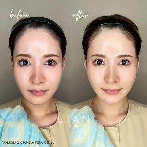 Hyaluronic acid (chin+temple)