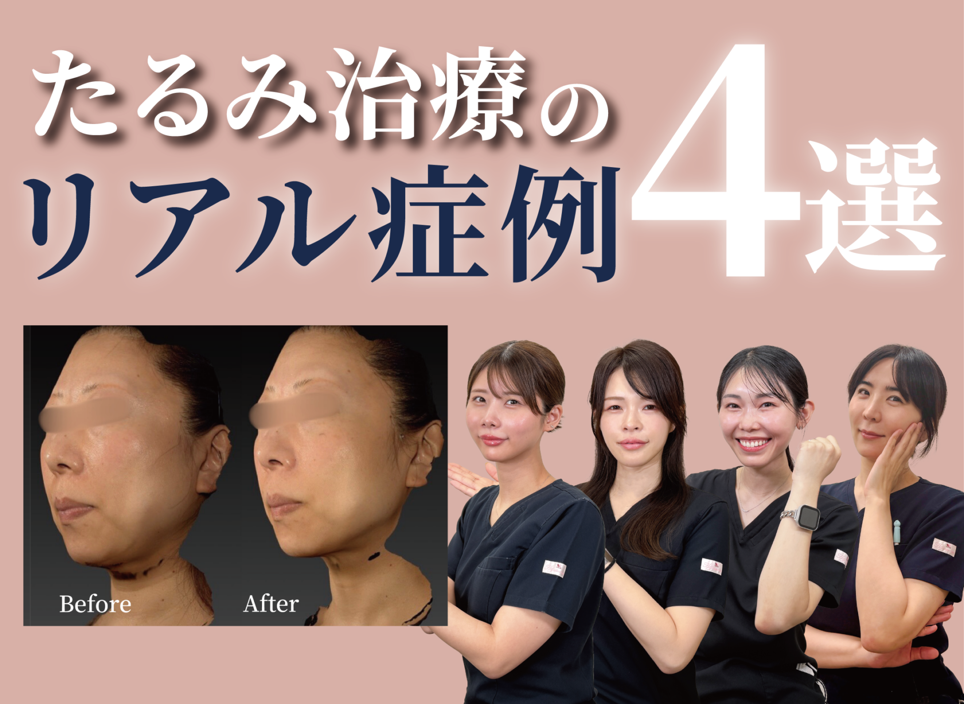【Youtube】第二弾‼︎看護師による、たるみ治療症例解説動画をUPしました。