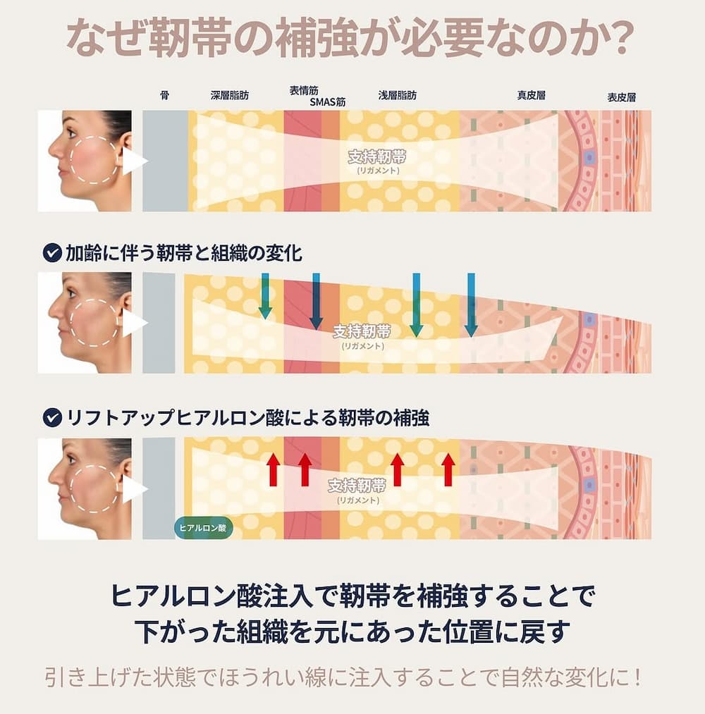 なぜ靭帯の補強が必要なのか
